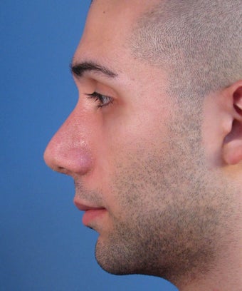 Revision Rhinoplasty
