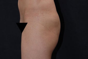 Buttock Augmentation with Gluteal Implant