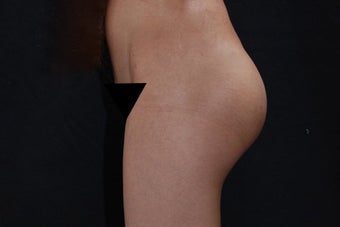 Buttock Augmentation with Gluteal Implant