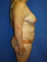 Mommy Makeover