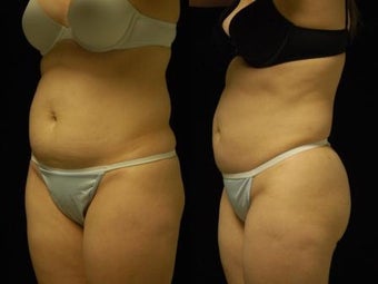 Smartlipo MPX abdomen, waist and flanks