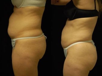 Smartlipo MPX abdomen, waist and flanks