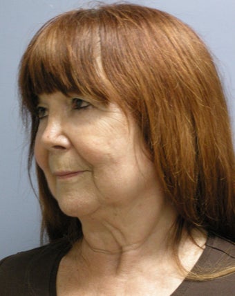 Facelift