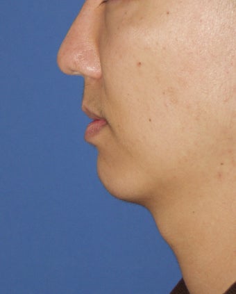 Chin Implant