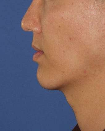 Chin Implant