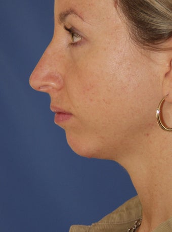 Chin Implant