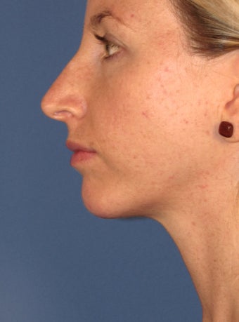 Chin Implant