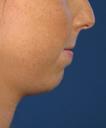 Chin Implant