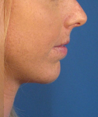 Chin Implant