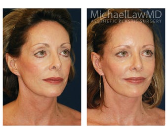 Cheek Augmentation