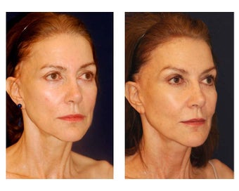 Cheek Augmentation