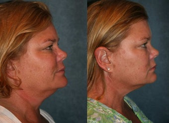 Ultherapy