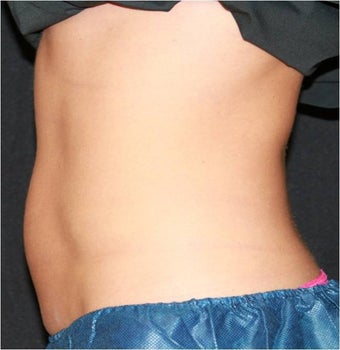 CoolSculpting