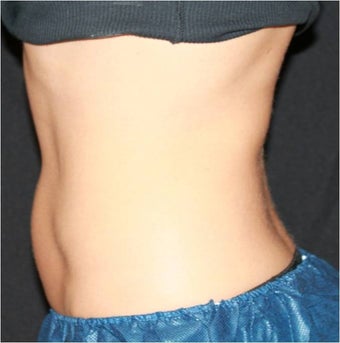 CoolSculpting