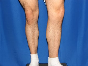 Calf Augumentation