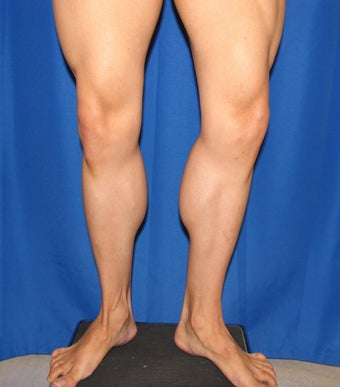 Calf Augumentation