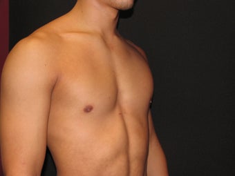 Pectoral Implants