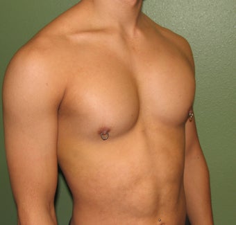 Pectoral Implants