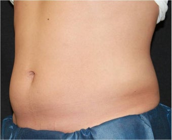 CoolSculpting