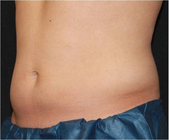 CoolSculpting