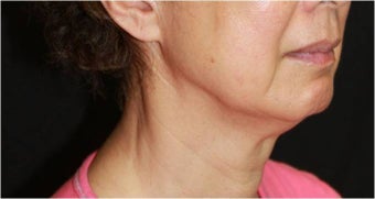 Ultherapy