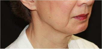 Ultherapy