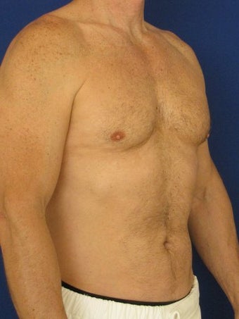 Vaser Hi Def Liposuction of chest, abdomen, back and flanks