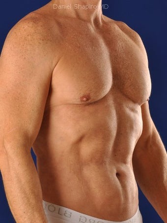 Vaser Hi Def Liposuction of chest, abdomen, back and flanks