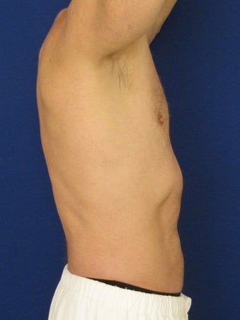 Vaser Hi Def Liposuction of chest, abdomen, back and flanks