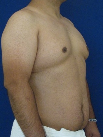 Vaser Hi-Def Liposuction of abdomen, chest, back and flanks