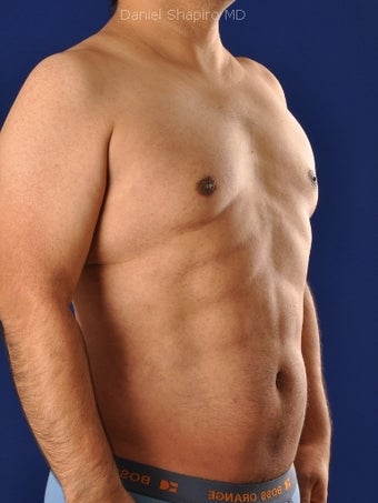 Vaser Hi-Def Liposuction of abdomen, chest, back and flanks