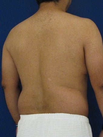Vaser Hi Def Liposuction of chest, abdomen, back and flanks