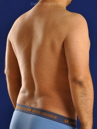 Vaser Hi Def Liposuction of chest, abdomen, back and flanks