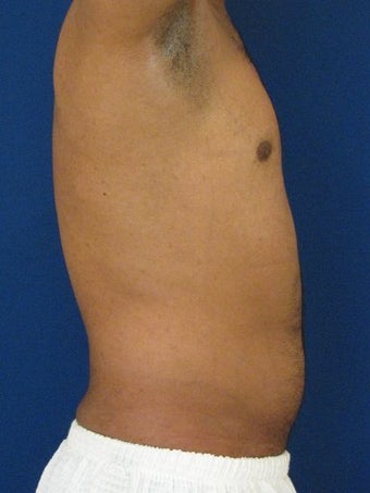 Vaser Hi Def Liposuction of the abdomen, chest, back, and flanks with fat injections to the pectoralis region