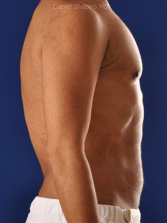 Vaser Hi Def Liposuction of the abdomen, chest, back, and flanks with fat injections to the pectoralis region