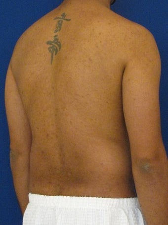 Vaser Hi Def Liposuction of the abdomen, chest, back, and flanks with fat injections to the pectoralis region