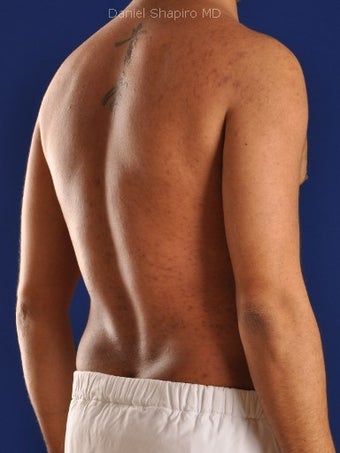 Vaser Hi Def Liposuction of the abdomen, chest, back, and flanks with fat injections to the pectoralis region