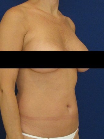 Vaser Hi Def Liposuction of chest, abdomen, back and flanks