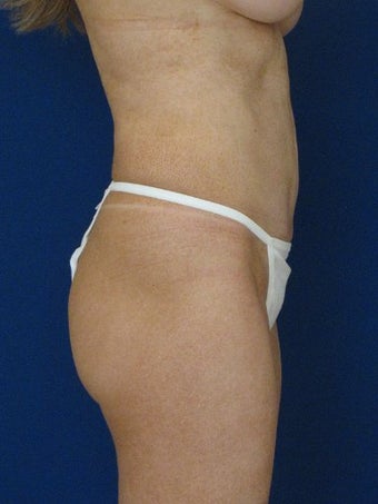 vaser Hi Def Liposuction of chest, abdomen, back and flanks