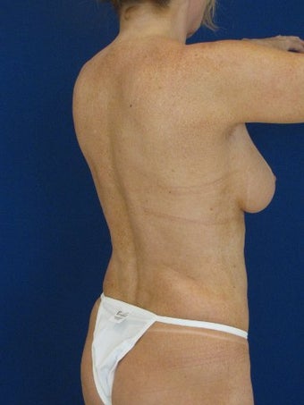 Vaser Hi Def Liposuction of chest, abdomen, back and flanks