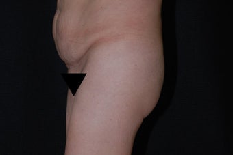 Buttock Augmentation through Fat Transfer