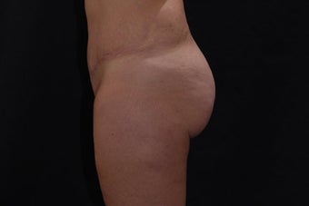 Buttock Augmentation through Fat Transfer