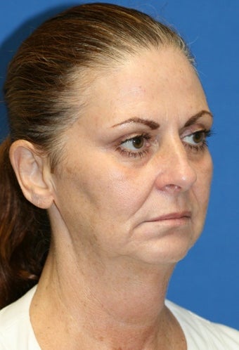 Facelift, Fat Transfer, Upper Bleph, Lower Eyelid Skin Pinch