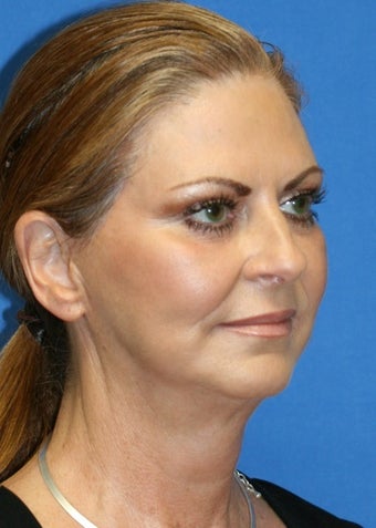 Facelift, Fat Transfer, Upper Bleph, Lower Eyelid Skin Pinch