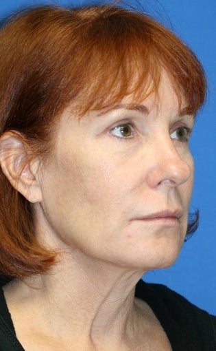 2 years post op: Facelift, Lower Eyelid Skin Pinch, and Peri-orbital Fat Transfer