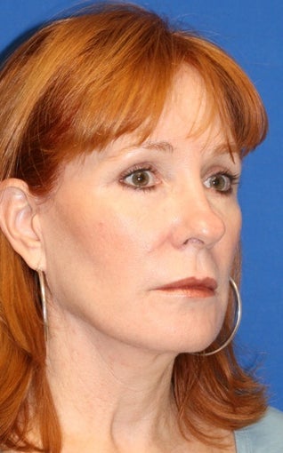 2 years post op: Facelift, Lower Eyelid Skin Pinch, and Peri-orbital Fat Transfer