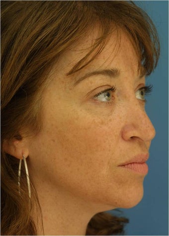 Revision Rhinoplasty