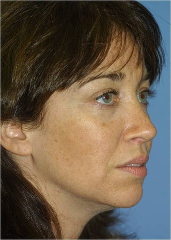 Revision Rhinoplasty
