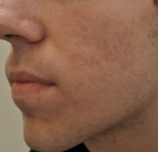 Acne Scarring