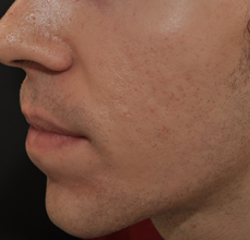 Acne Scarring